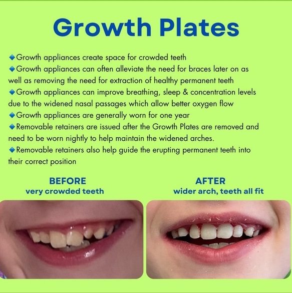 Growth Plates