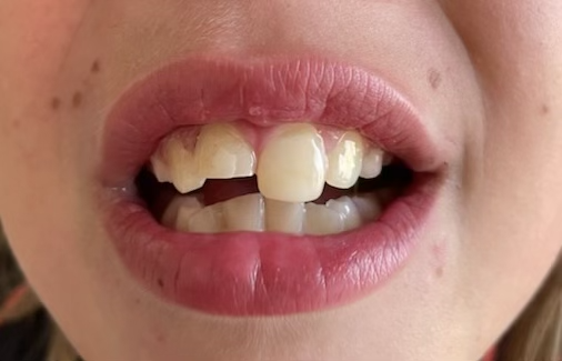 dental_trauma_before